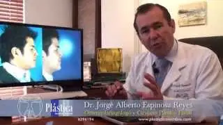 Testimonio con Fotos Reales en Rinoplastia Masculina Ancha - Dr. Jorge Alberto Espinosa Reyes