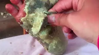 How to removal skin | callus removal skin flakes #39