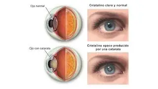 Lasik and Cataract Surgery - Frequently Asked Questions | Oftalvist