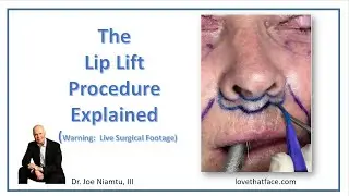 The Lip Lift Explained and Live Surgical Footage