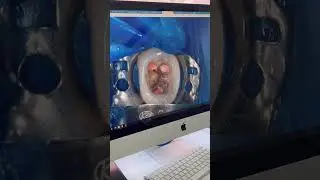 Лечение зуба ПОД КОРОНКОЙ 😱😱😱