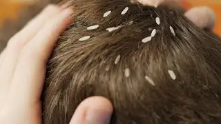 Самые страшные паразиты человека!  часть 2