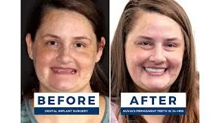 The SECRET to Getting Your Smile Back | Permanent Teeth In 24 Hours