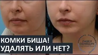 Bish's Lumps: To Remove or Not to Remove? | Questions and Answers