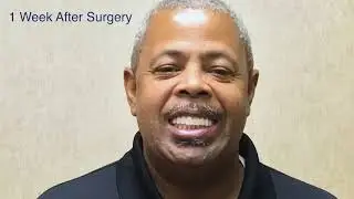 All-on-4 Dental Implant Remakes Anthony's Smile