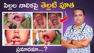 చిన్నపిల్లల నాలుకపై తెల్లటి పూత, white coating on baby tongue in telugu, oral thrush in babies