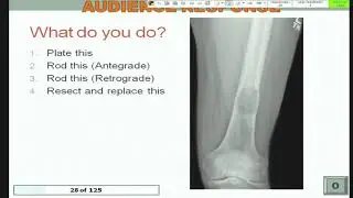 Management of pathological fractures