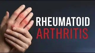 Rheumatoid Arthritis: Causes, Symptoms & Diet Plan Explained | Nutrishilp