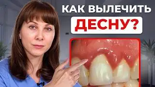 A FAST way to relieve gum inflammation at home! What happens if gingivitis is left untreated?