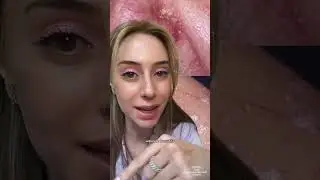 Dandruff Psoriasis And Dry Scalp 