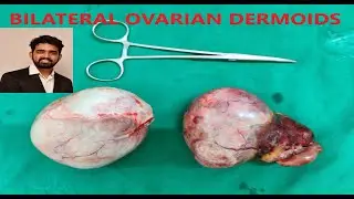 LAPAROTOMY FOR BILATERAL DERMOID CYST USING LIGASURE