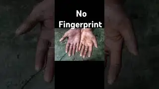 इस ladke के हाथ में fingerprints ही नहीं है,🧐🤔🧐