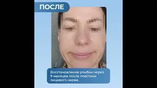 Пластика лицевого нерва. лечение в нии микрохирургии