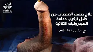 علاج ضعف الانتصاب من خلال تركيب دعامة الهيدروليك الثلاثية \ مع الدكتور اسامة غطاس