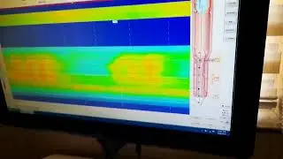 High Resolution Solid State Anorectal Manometry with Biofeedback Session by ManoScan