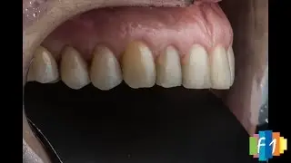 Como utilizar um espelho de Contraste para documentação odontológica