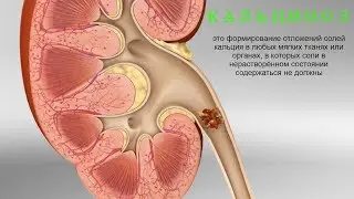 Кальциноз! Что делать?