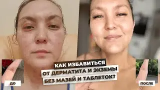 История исцеления от атопического дерматита и экземы у Гульжан! Проблемы с кожей ушли навсегда