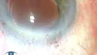 Endophthalmitis Phaco 3.1 Complications