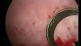 Magic of hysteroscopy with Shawki, Cesarian section scar ectopic pregnancy