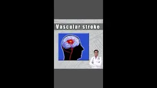 what is stroke ? ब्रेन स्ट्रोक के लक्षण in Hindi