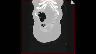 Virtual colonoscopy with cancer in transverse colon