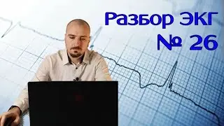 Разбор ЭКГ №26
