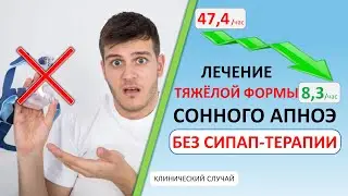 Лечение тяжёлой формы сонного апноэ без СИПАП-терапии | Разбор реального случая