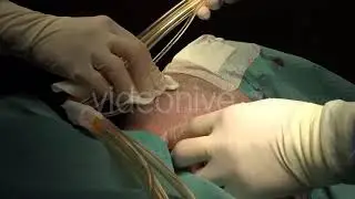Neck Liposuction For Men 7 | Stock Footage - Envato elements