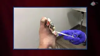WCW: Amputating Necrotic Toes after Frostbite Injury