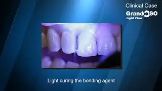 Clinical Tip:   GrandioSO Light Flow Clinical Case