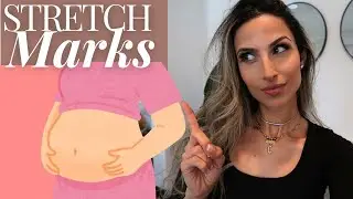 Secrets to Stretch Mark Free Pregnancy Even When You're Stretch Mark Prone!