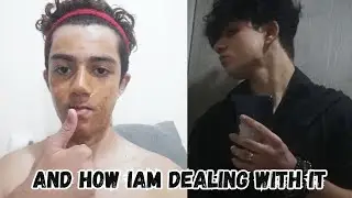 lets talk teenage hair loss (rawtalks17)