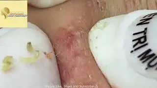 BIG Blackheads Removal   Acne Treatment   SPA ASMG   Blackheads on face #72