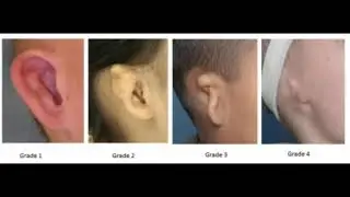 Busco el apoyo de todos ustedes para cumplir mis sueños de ser como ustedes(tengo microtia grado 2)