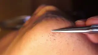 Hair removal asmr pull out with Tweezers  Satisfying pull out beard 12min 202403-5