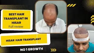 Best hair Transplant in hisar | cost  Hair transplant in india|best Hair transplant in delhi|
