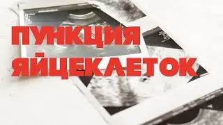 Как прошёл забор яйцеклеток|пункция яйцеклеток