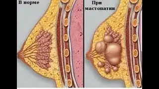 Rapid treatment of lactostasis and mastitis during breastfeeding