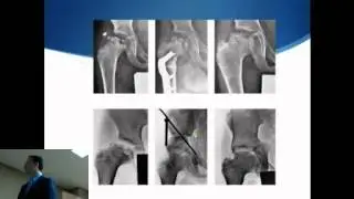 Legg-Calvé-Perthes