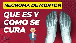 NEUROMA DE MORTON: QUE ES Y COMO SE CURA 🦶💥