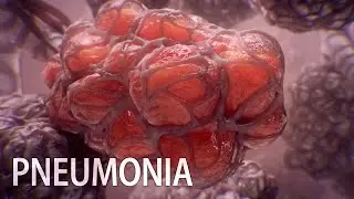 Pneumonia and the pivotal role of alveoli | medical animation