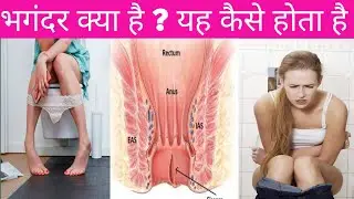 भगंदर की शुरुआत कैसे होती है।। भगंदर की पहचान क्या है।। What is Pistula ?