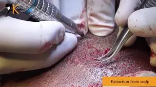 Extraction from Scalp & Beard in Patient of Curly Hair