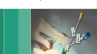 TECNICA INSERCION CORTA CERTOFIX