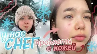 VLOG Winter VIBE ✨ My skin problems...