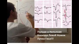 ПОЛНАЯ И НЕПОЛНАЯ БЛОКАДА ЛЕВОЙ НОЖКИ ПУЧКА ГИСА!!!