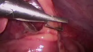 DS Ligation Clip System for Laparoscopic Appendicectomy, AESCULAP