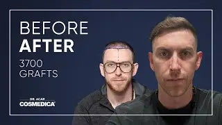 Hair Transplant in Turkey | Results | Dr. Acar | Cosmedica Clinic