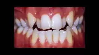 orthodontie linguale